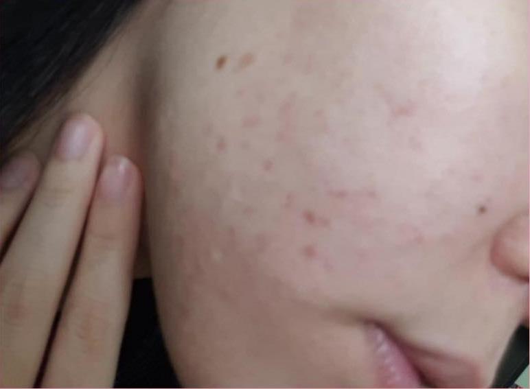 After Treatment - Clear, even skin tone
