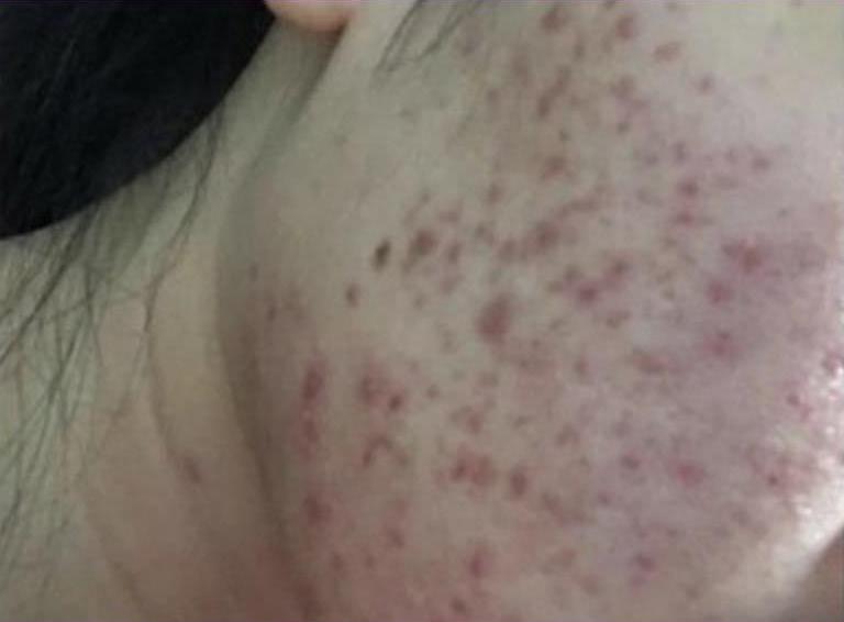 Before Treatment - Skin with pigmentation
