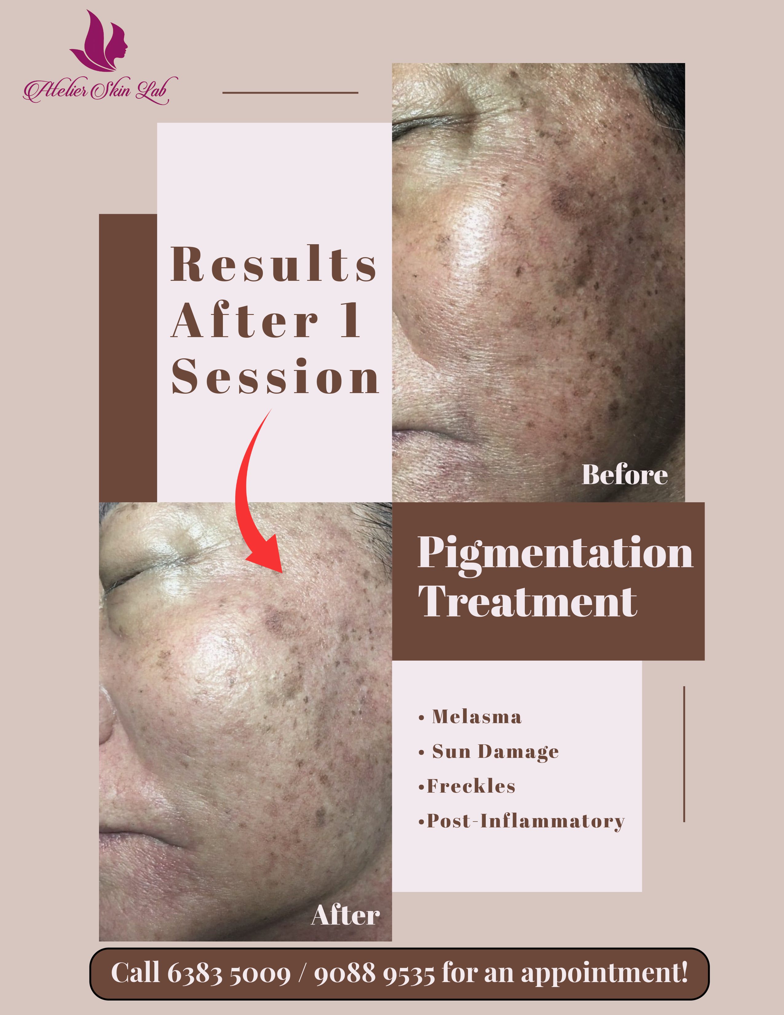 Pigmentation Treatment Results - Before & After